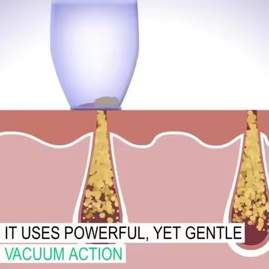 Moonova™ | Derma-Suction Blackhead Remover